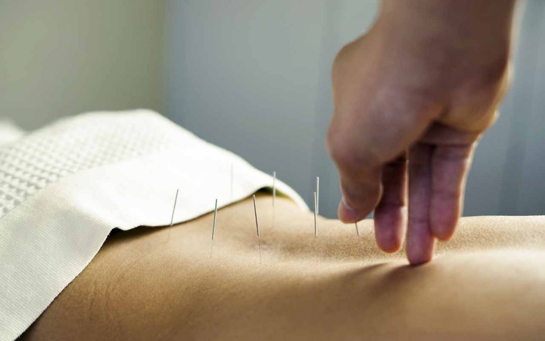 Acupuncture for Pain Relief
