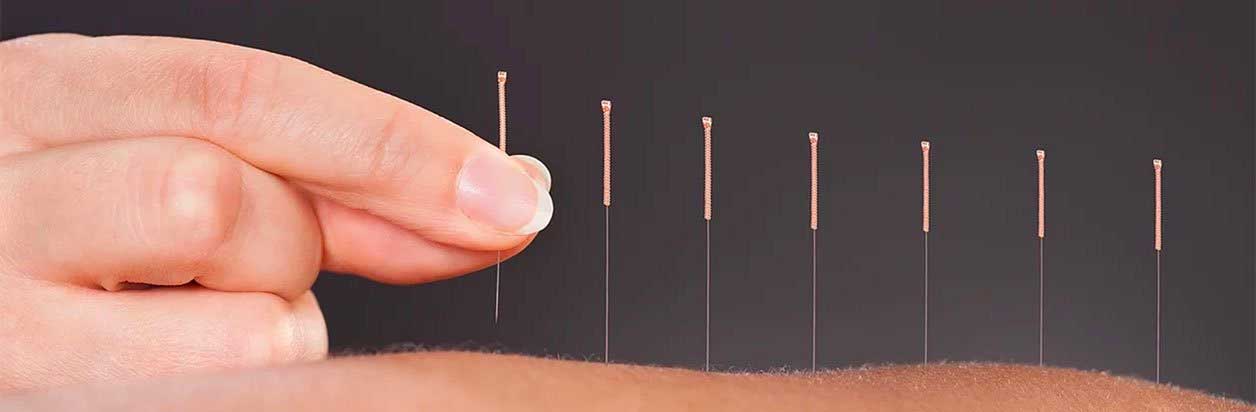 https://acaacupuncture.com/wp-content/uploads/2020/02/acupuncture-for-pain-management.jpg