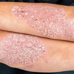Acupuncture for psoriasis