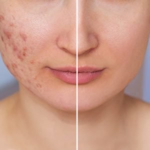 Acupuncture for acne