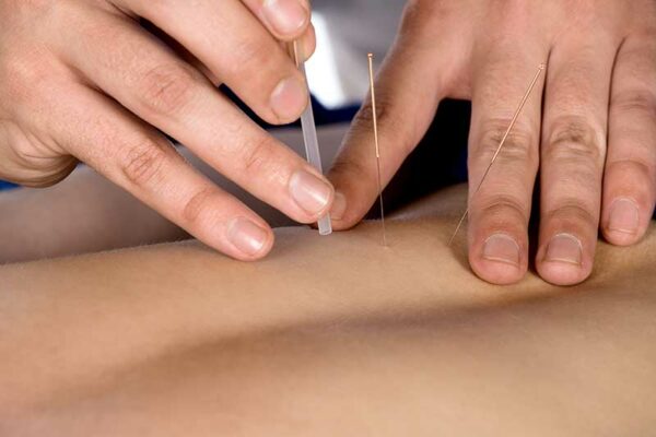 Voucher - Acupuncture Treatment