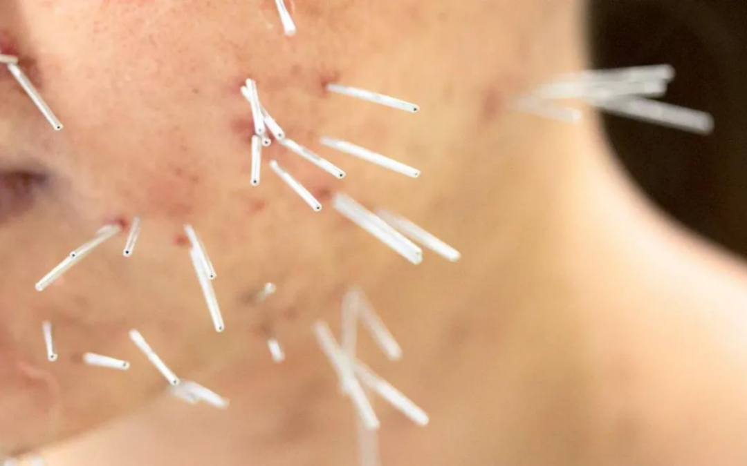 Acupuncture for Acne in Teenagers: Holistic Solution for Clearer Skin
