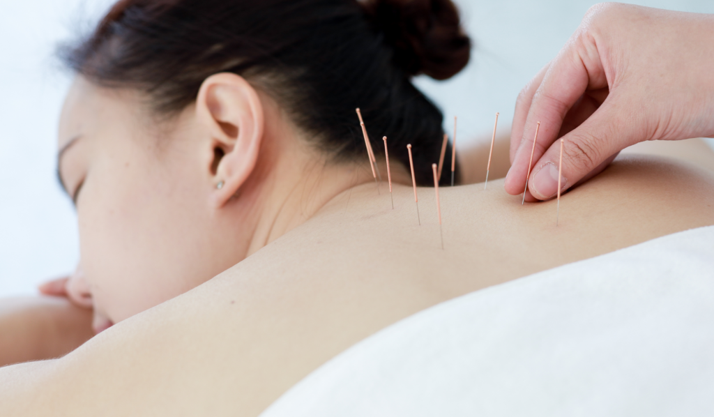 Acupuncture for Back Pain