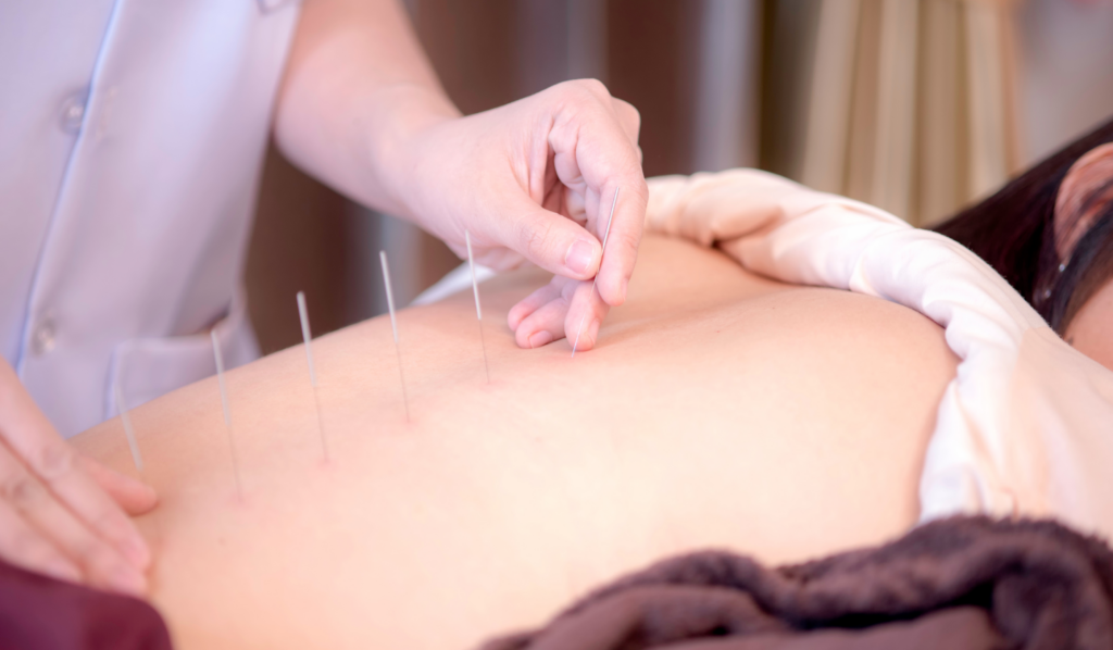 Why You Should See an Acupuncturist if You Have Back Pain