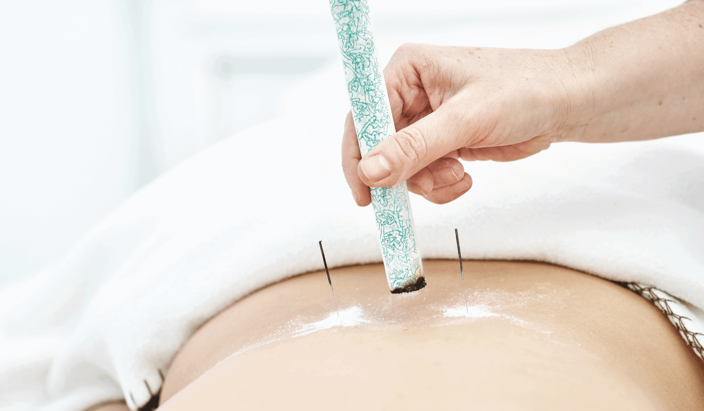 Moxibustion | ACA Acupuncture and Wellness