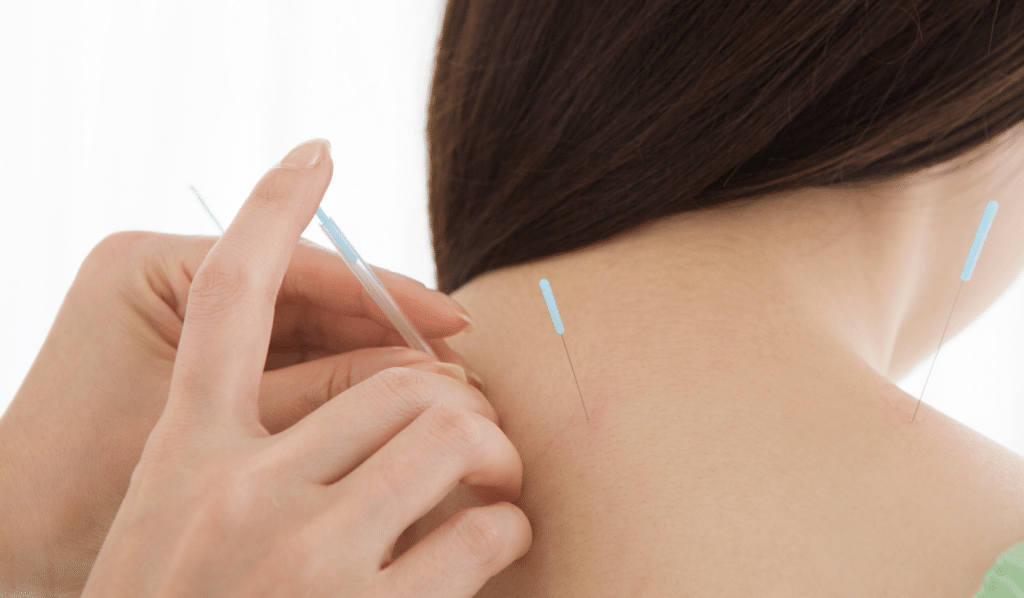 How Acupuncture May Help ADHD in Teenagers