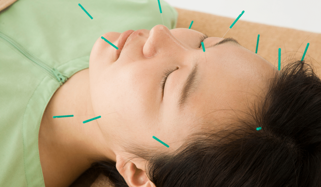 A Holistic Path to Managing ADHD with Acupuncture