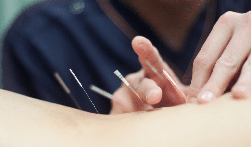 acupuncture and muscle knots | ACA Acupuncture and Wellness