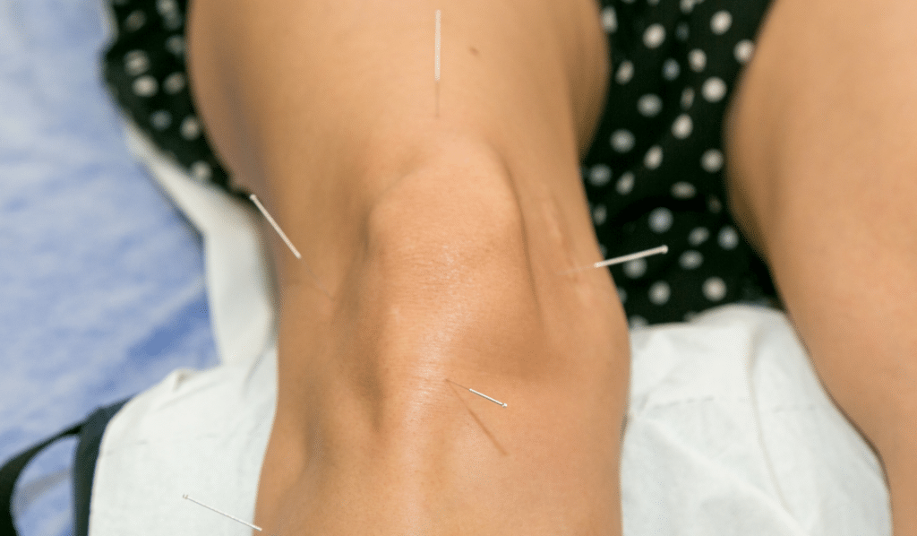 Acupuncture for Knee Pain Management