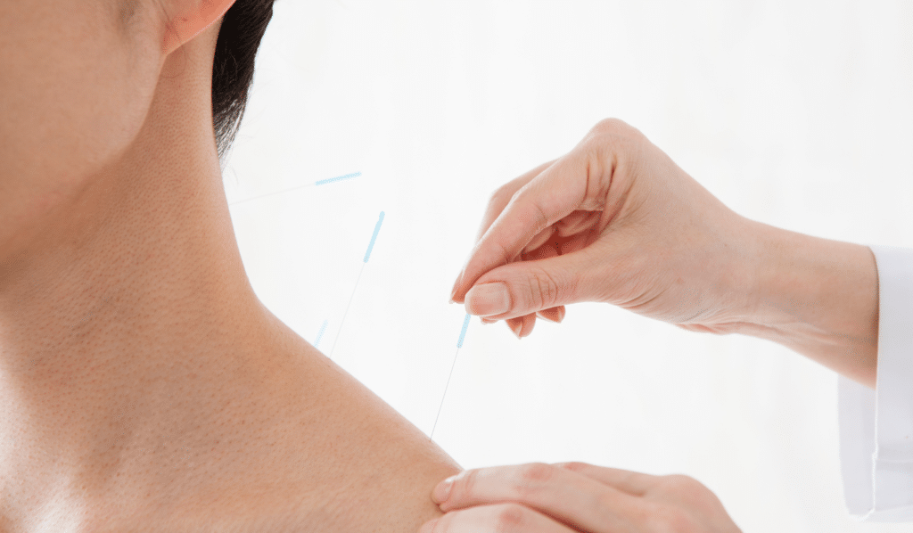 Acupuncture for Frozen Shoulder and Neck Pain