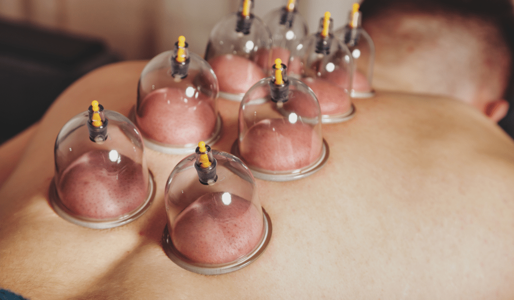 Common Side Effects of Cupping Therapy and Recovery Tips