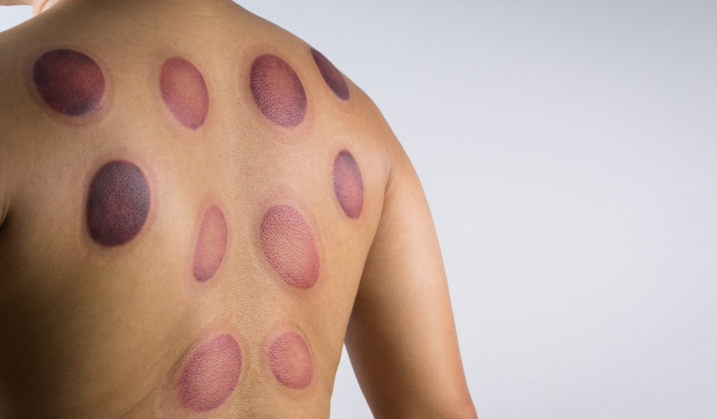 Post Cupping Therapy