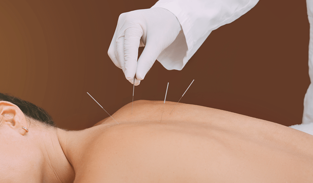Acupuncture and Its Potential Benefits for People Living with HIV/AIDS