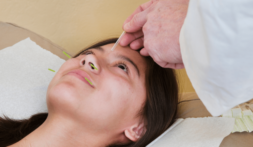 Facial Acupuncture
