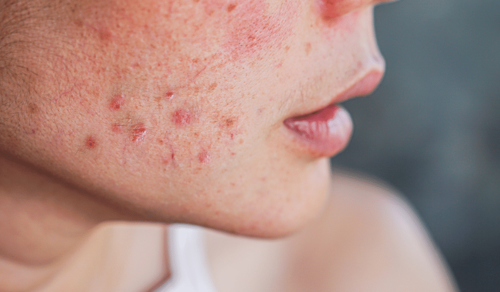 Teenage Acne Causes and Challenges