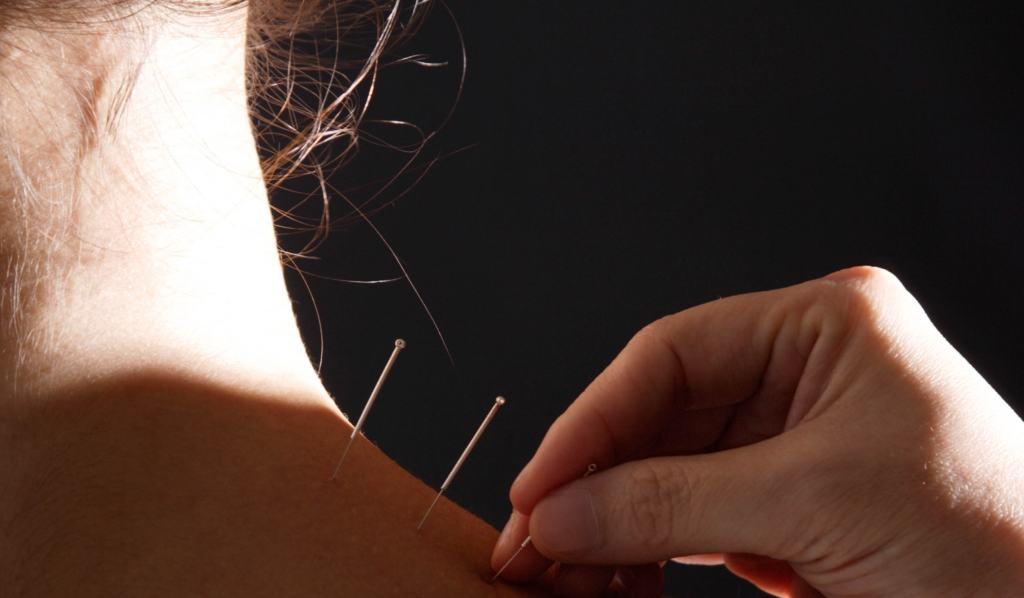 Acupuncture Hot Flashes