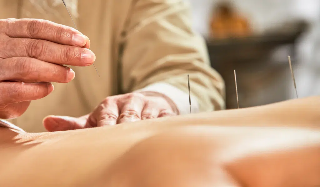Acupuncture and Acupressure