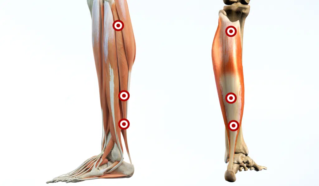 Common Soleus Trigger Points
