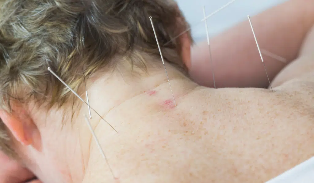 Why Acupuncture is a Practical Choice for Elderly Patients