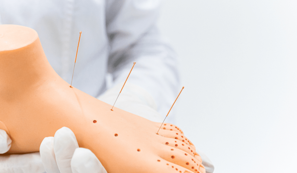 Acupuncture Points for Plantar Fasciitis