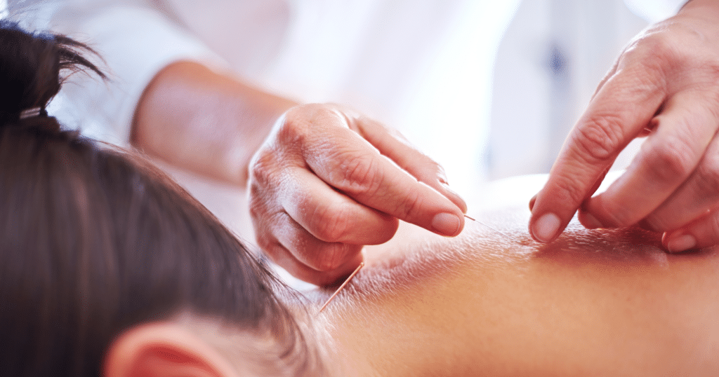 How Acupuncture Balances Meridian Pathways