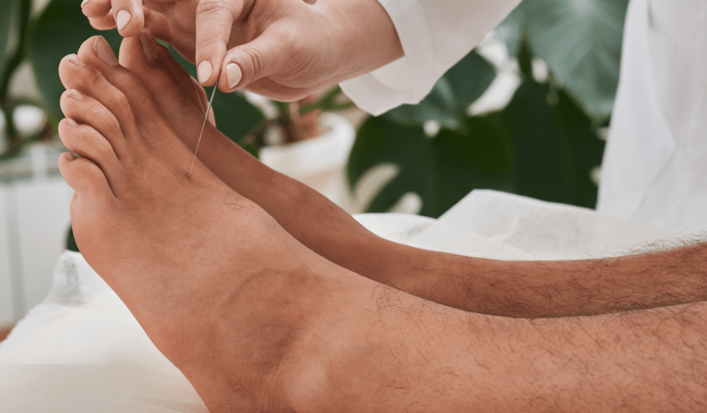 How Acupuncture Helps with Plantar Fasciitis