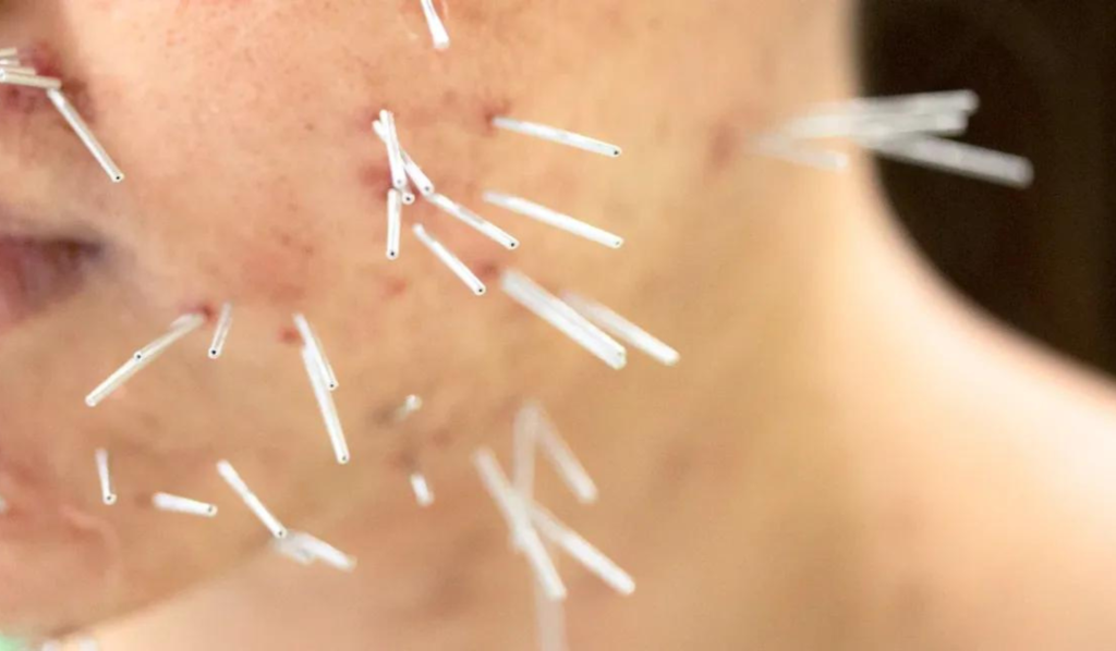 Role of Acupuncture in Promoting Inner Peace ACA Acupuncture and Wellness