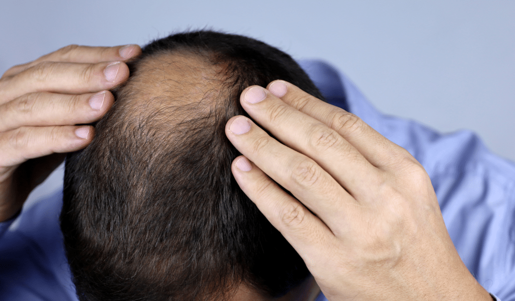 Understanding Hair Loss in Traditional Chinese Medicine