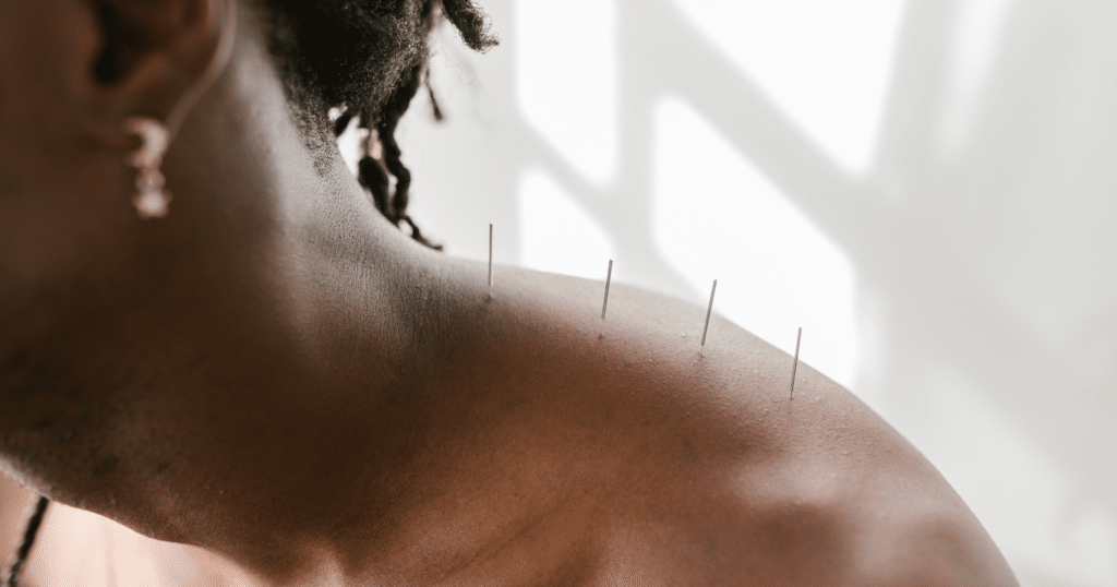 What is Acupuncture?