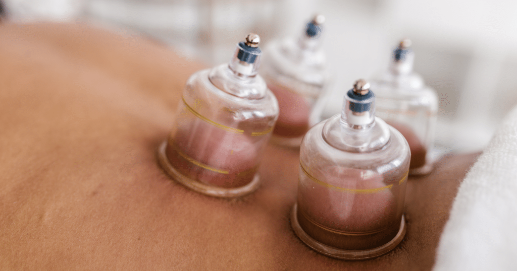 Cupping Therapy for Sciatica