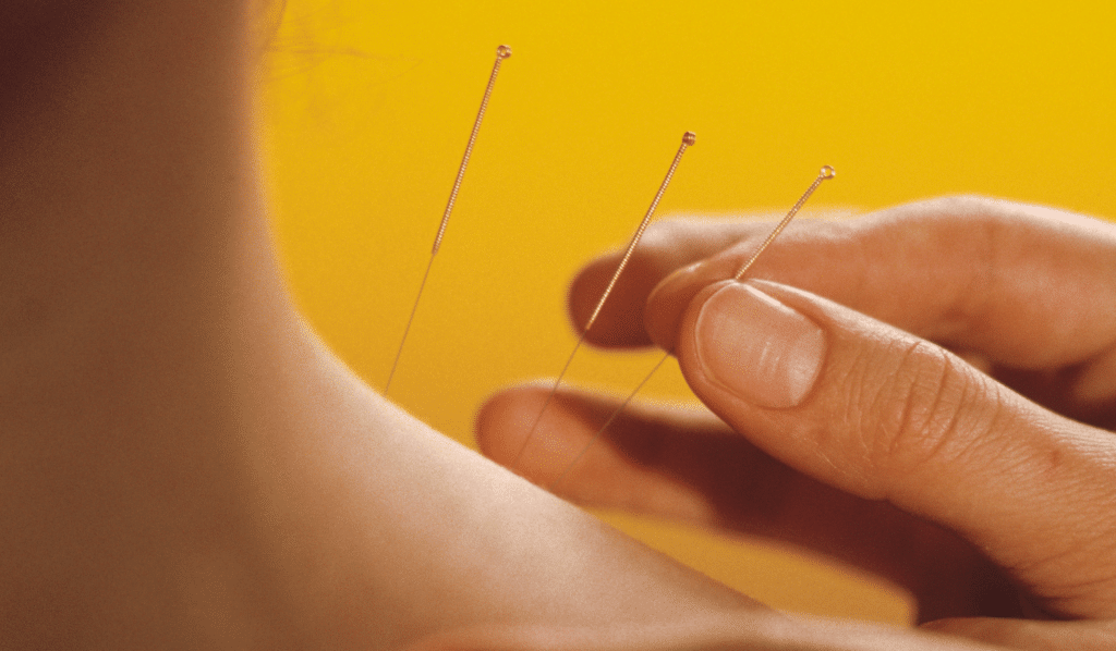Detox Symptoms After Acupuncture
