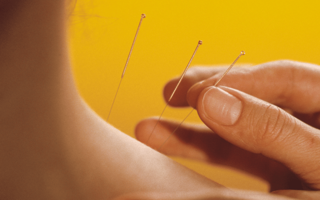 Detox Symptoms After Acupuncture: What to Expect and How to Support Your Recovery
