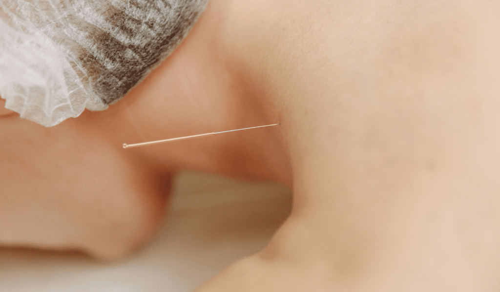 Who Experiences Detox Symptoms After Acupuncture