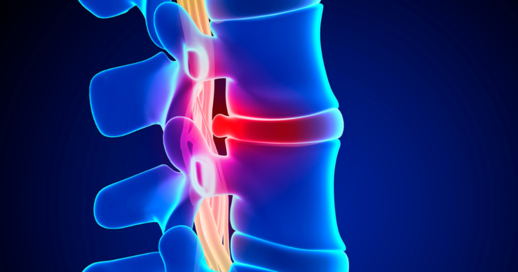 understanding-slipped-disc