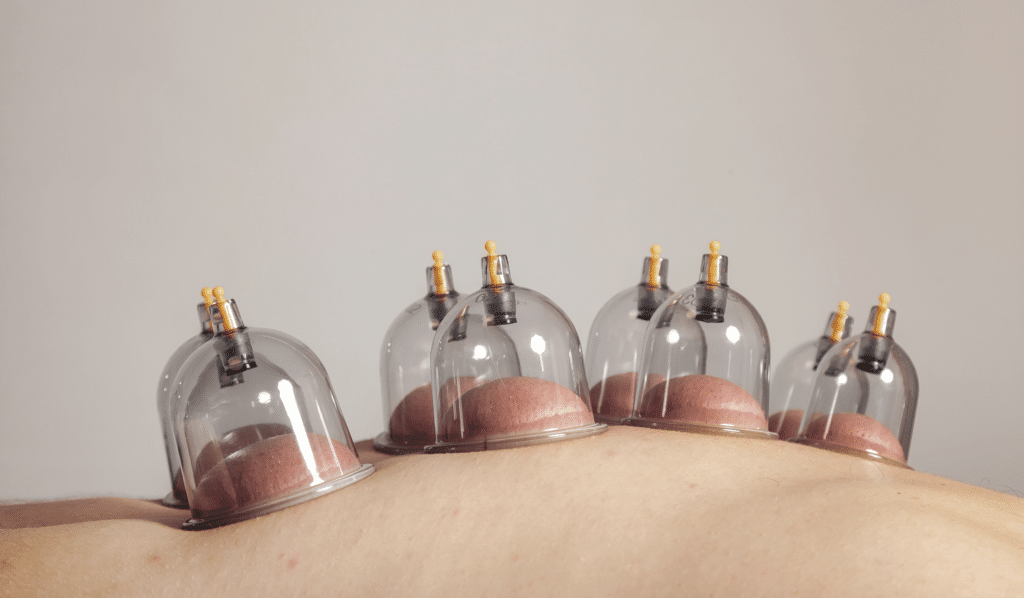 How Often Should You Do Cupping for Weight Loss