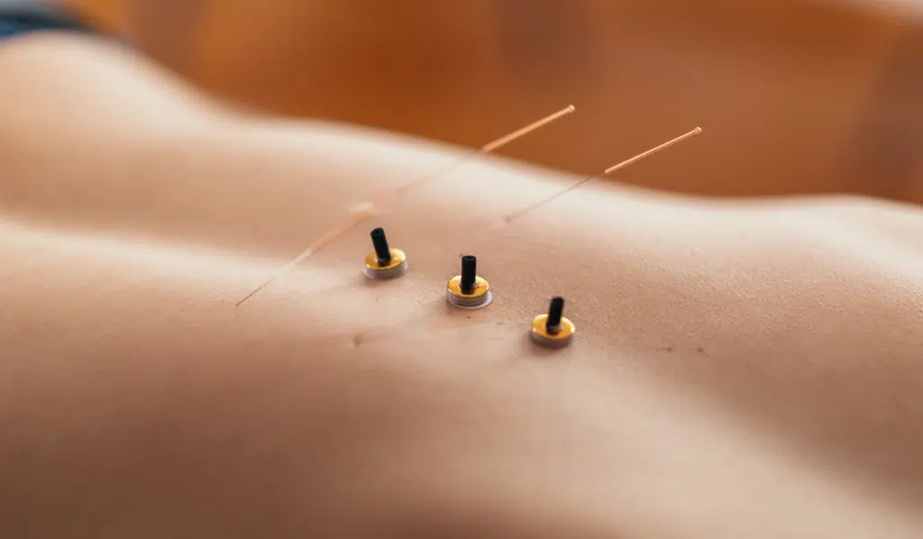 Therapeutic Benefits of Moxibustion in Acupuncture