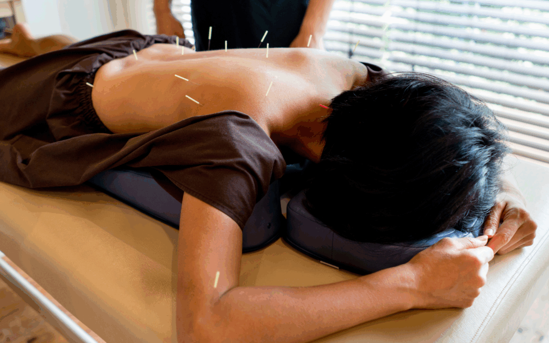 How Often Should You Get Acupuncture? Full Guide