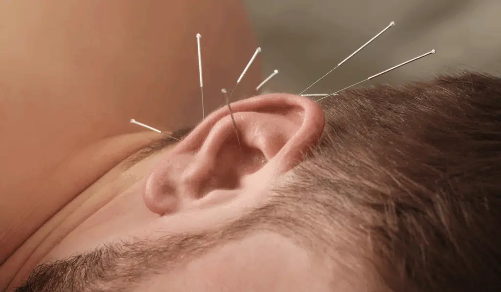 Auricular (Ear) Acupuncture_ What It Treats, How It Works, and Who It’s For