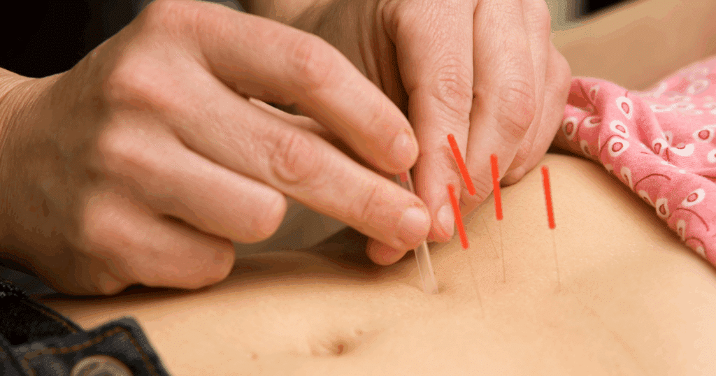 acupuncture-and-moxibustion-for-irritable-bowel-syndrome-ibs-a-holistic-approach-to-gut-health