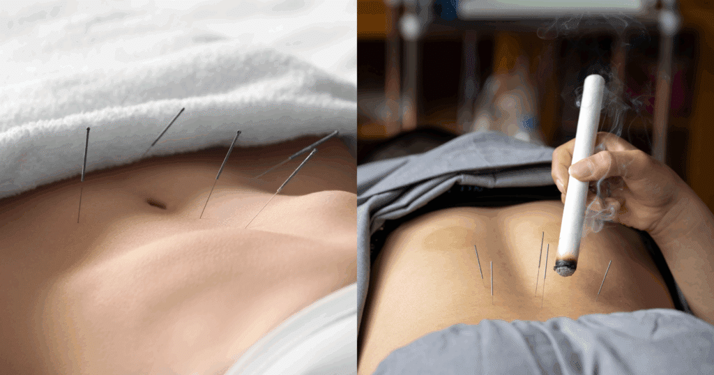 how-acupuncture-and-moxibustion-work-for-ibs