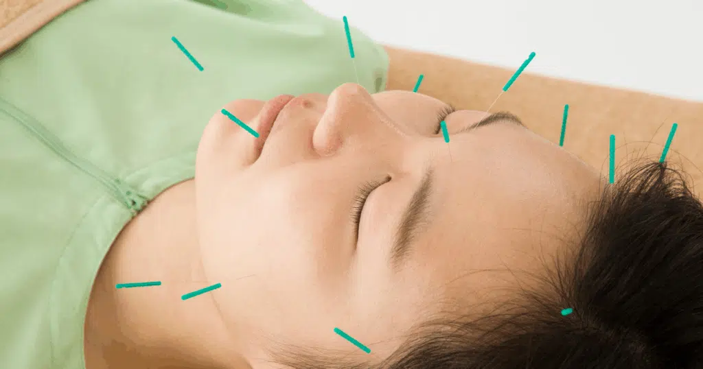 what-is-facial-acupuncture
