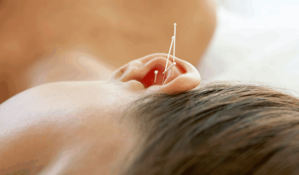 acupuncture for sleep