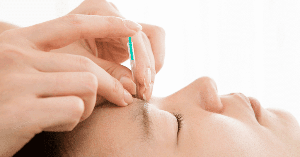 facial-acupuncture-benefits-natural-rejuvenation-and-collagen-boost