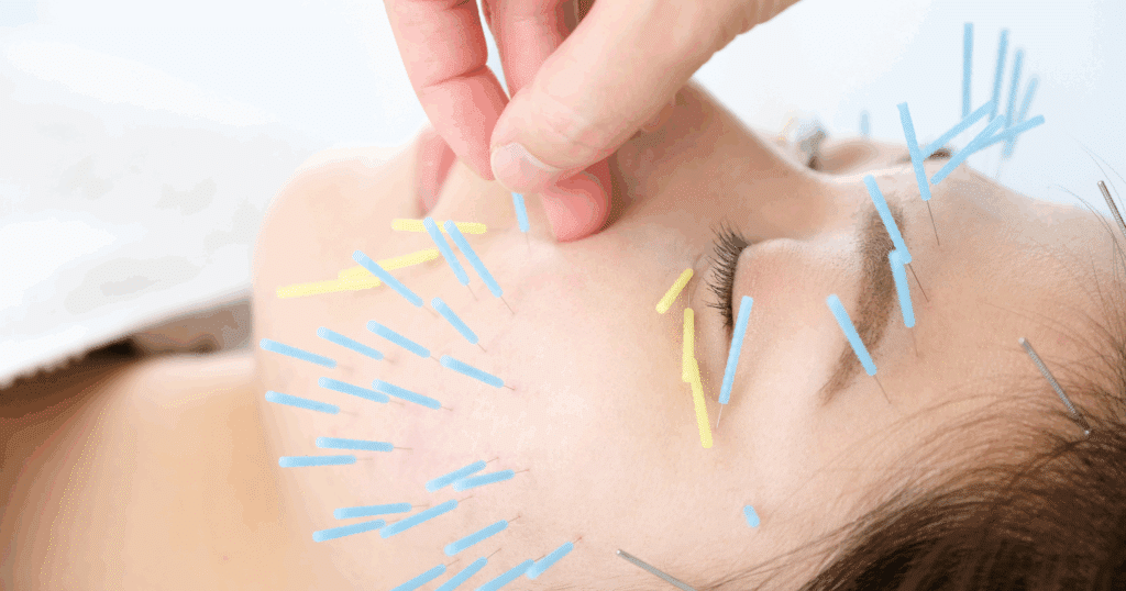 what-to-expect-from-your-first-acupuncture-session