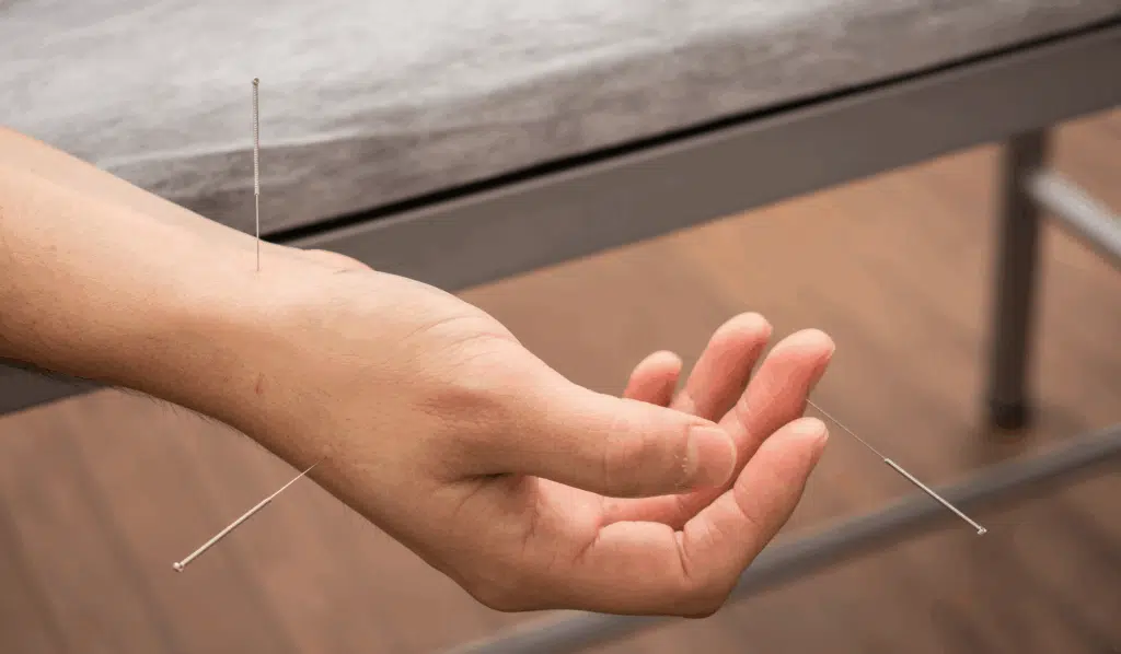 How Acupuncture May Relieve CTS