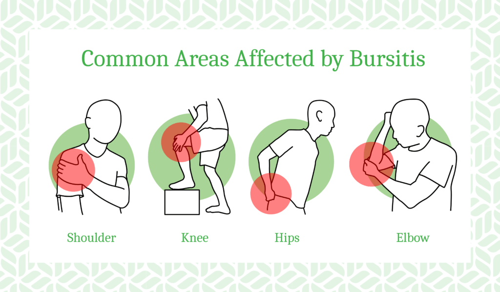 What Is Bursitis