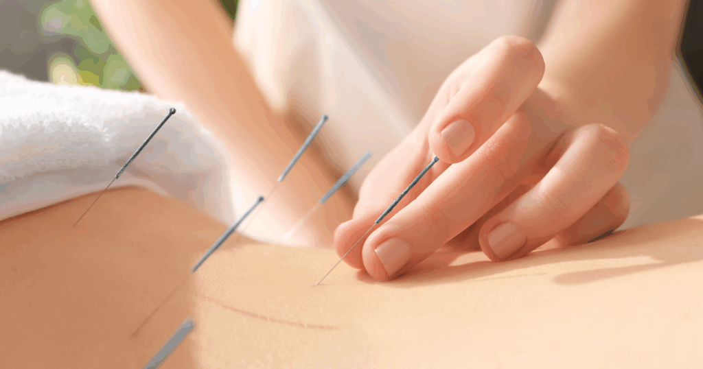 acupuncture-as-a-traditional-therapy-for-stress-and-anxiety-relief