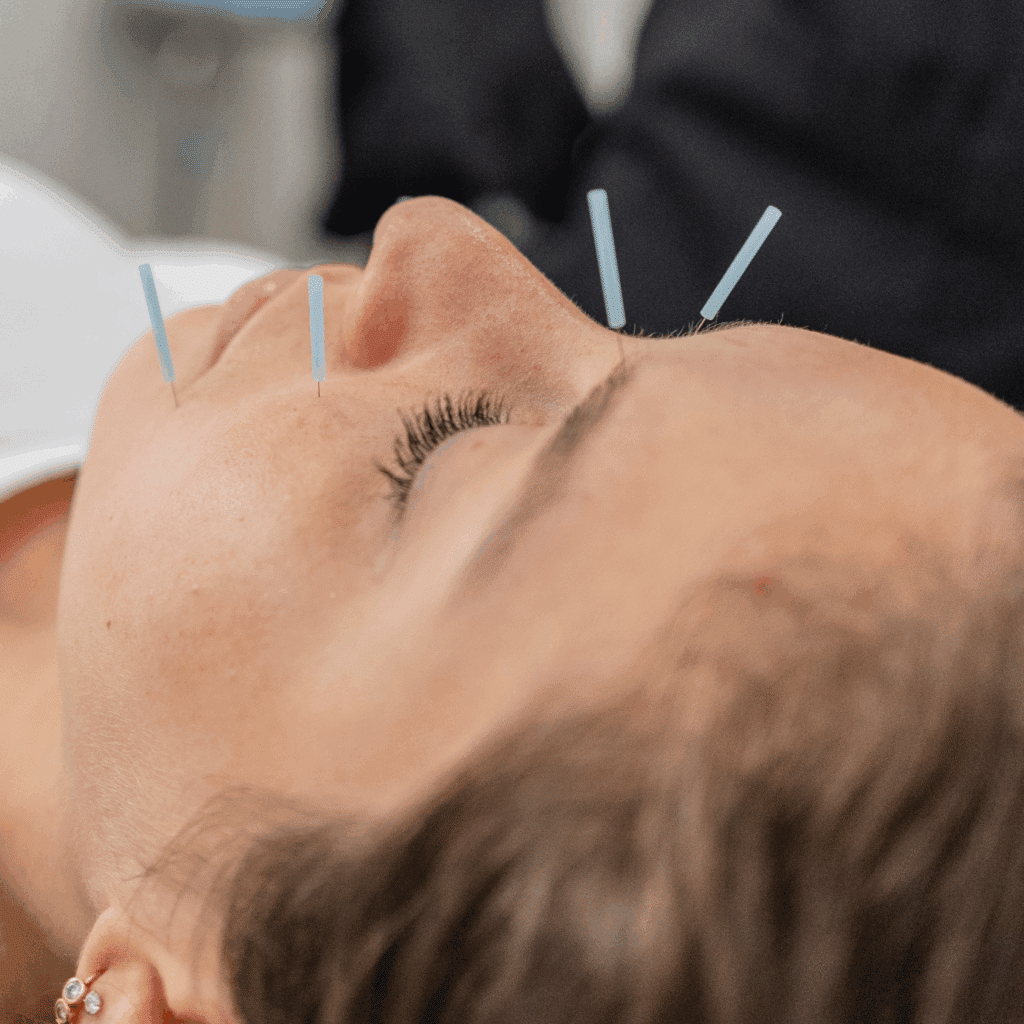 Facial Acupuncture