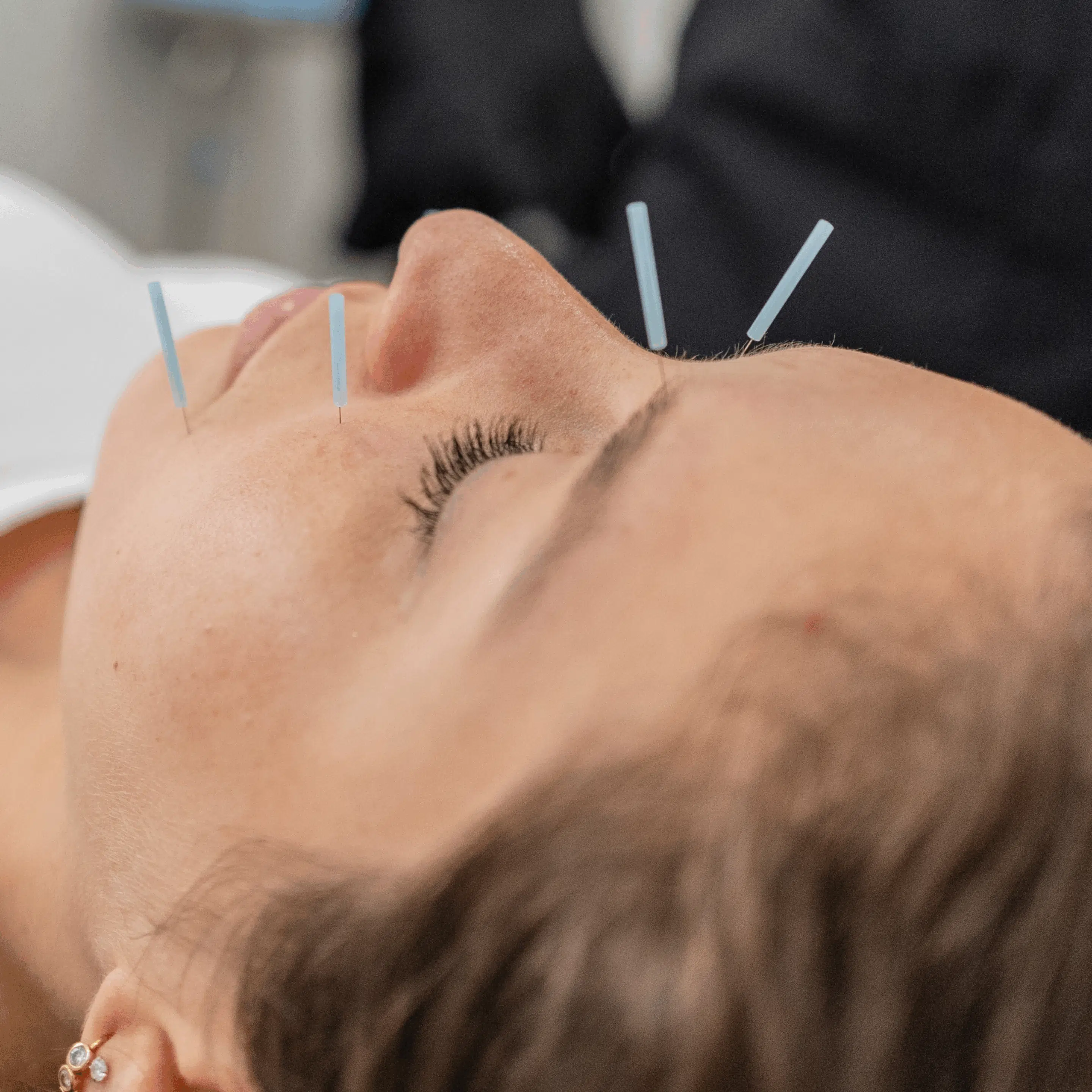 Facial Acupuncture