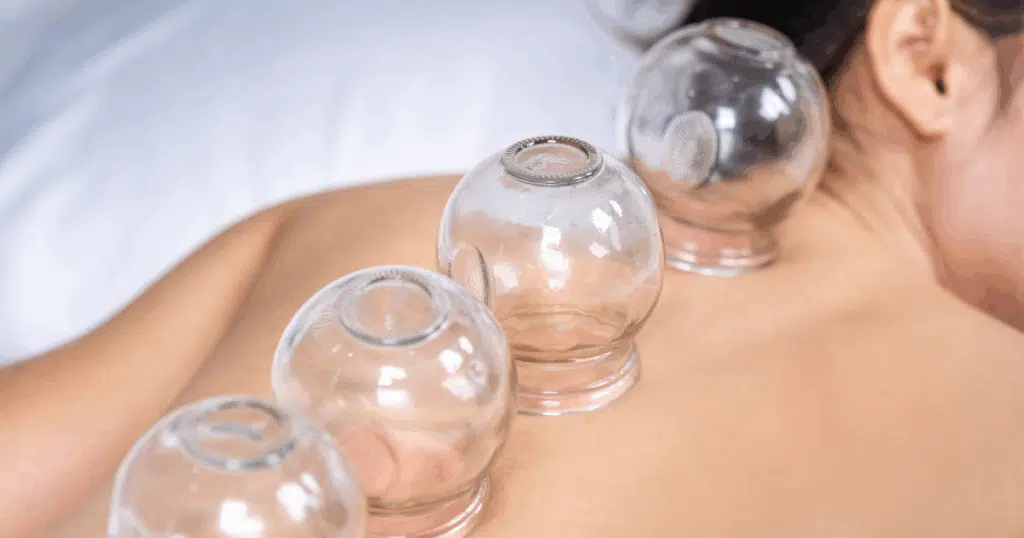 Integrative Respiratory Care: Cupping in Clinical Context